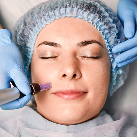 Microneedling Tlc Medical Aesthetics